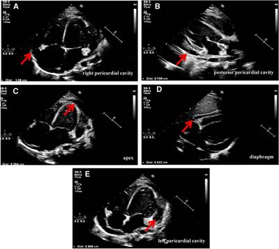 Assistance of metagenomics next-generation sequencing for diagnosis of adenovirus pericarditis with pericardial effusion in a child: a case report and literature review